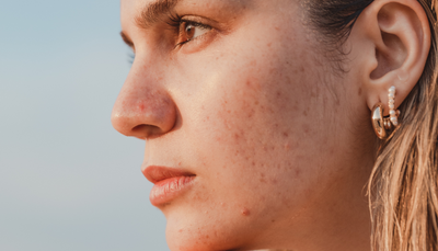 Acne Scarring: Causes, Treatments, and Phyla's Role