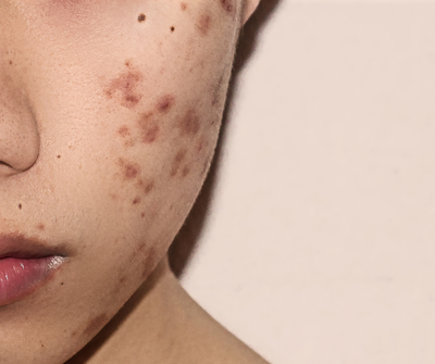 Why Does Cystic Acne Happen?