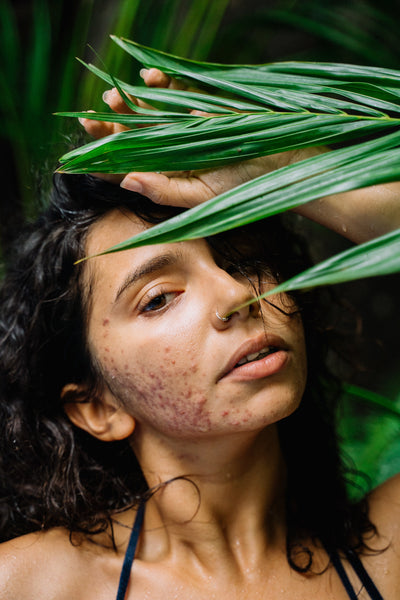 The Acne Quick Fix: More Harm Than Good?